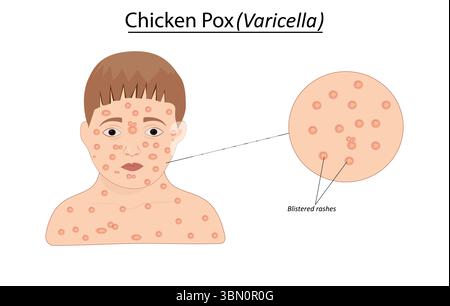 Illustration vectorielle de varicelle de poulet Illustration de Vecteur