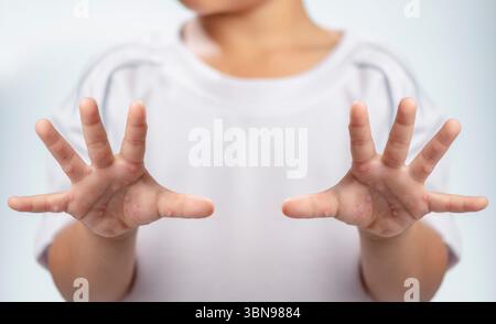 Maladie des mains, des pieds et de la bouche HFMD main humaine de la scarlatine dans le virus coxsackievirus palmarosa virus et main de l'enfant sur fond blanc Banque D'Images