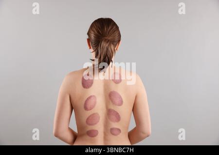 Femme après la thérapie de cupping sur fond gris Banque D'Images