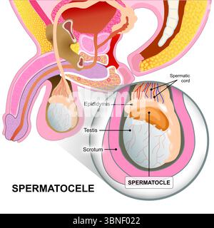 Spermatocèle dans le testicule masculin illustration Banque D'Images