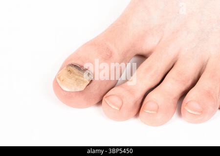 Ongle Clloseup avec infection fongique visible et plaque épaissie de l'ongle sur le pied. Concept de podologie et d'hygiène Banque D'Images