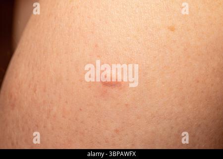 Tissu cicatriciel chéloïde se développant sur la peau après un traumatisme, créant une surface irrégulière surélevée souvent de couleur rose ou rouge Banque D'Images