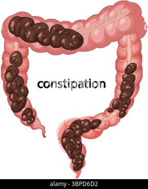 Illustration vectorielle du côlon humain montrant la constipation. Représentation anatomique détaillée avec des couleurs réalistes et un étiquetage clair Illustration de Vecteur