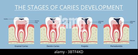 Stades de la carie. Processus graduel de carie dentaire, violation de l'intégrité de l'émail, programme d'éducation dentaire, affiche médicale sur les maux de dents, clinique de stomatologie Illustration de Vecteur