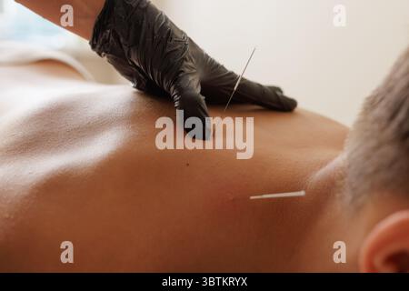 Gros plan d'une séance d'aiguilletage à sec pour le soulagement de la douleur musculaire et la rééducation, effectuée par un thérapeute professionnel Banque D'Images