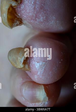 Infection fongique des orteils – Macro Shot avec traitement de crème médicale. Banque D'Images
