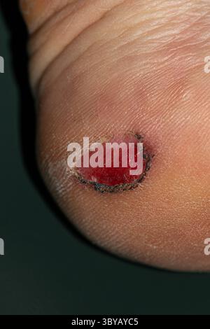Photo macro détaillée d'une plaie au pied au talon, mettant en évidence les tissus rouges bruts, la peau fissurée sèche et l'inflammation environnante, utile pour les applications médicales, podia Banque D'Images