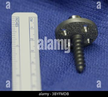 13 juin 2005 - États-Unis - KRT US NEWS STORY SLUGGED : MED-SHOULDERPAIN KRT PHOTOGRAPHIE PAR MARY SCHROEDER/DETROIT PRESSE LIBRE (4 juillet) partie du dispositif à bille et douille inversée qui est entré dans l'épaule de Lorraine Walby. (cdm) 2005 (crédit image : © Mary Schroeder/Detroit Free Press via ZUMA Press Wire) Banque D'Images