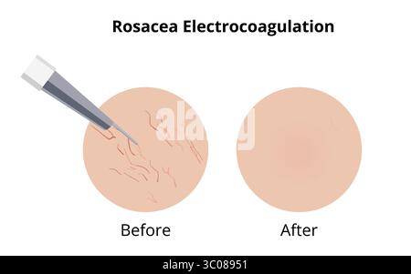 Traitement d'électrocoagulation enlevant les veines de couperose de rosacée avant et après, montrant l'efficacité de la procédure dans l'élimination du sang visible Illustration de Vecteur