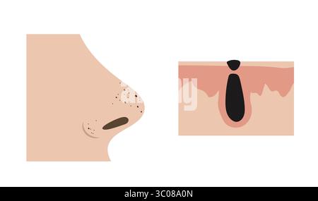 Points noirs obstruant les pores du nez et détail anatomique de la formation du comède Illustration de Vecteur