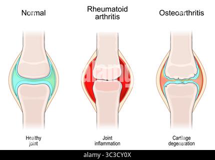 Pathologie articulaire comparée. Articulation saine, polyarthrite rhumatoïde, arthrose. Articulation normale, trouble auto-immun et inflammation articulaire, env Illustration de Vecteur