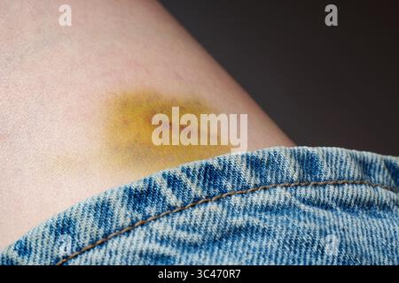 Gros plan d'une ecchymose sur une peau claire près du bord d'un vêtement en denim. L'ecchymose a une teinte vert jaunâtre, indiquant un stade tardif de guérison. Banque D'Images