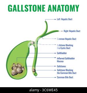 Une illustration montrant l'anatomie des calculs biliaires montre les canaux biliaires de la vésicule biliaire et les calculs mettant en évidence leur taille, leur forme et leur emplacement dans la voie biliaire Illustration de Vecteur