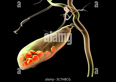 Illustration d'une vésicule biliaire avec des calculs, montrant la lithiase biliaire. Les calculs biliaires peuvent bloquer le flux biliaire et causer de la douleur, de l’inflammation ou une infection nécessitant un traitement médical ou chirurgical. Banque D'Images