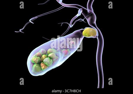 Illustration d'une vésicule biliaire avec des calculs, montrant la lithiase biliaire. Les calculs biliaires peuvent bloquer le flux biliaire et causer de la douleur, de l’inflammation ou une infection nécessitant un traitement médical ou chirurgical. Banque D'Images
