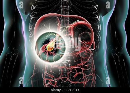 Illustration d'une vésicule biliaire avec des calculs, montrant la lithiase biliaire. Les calculs biliaires peuvent bloquer le flux biliaire et causer de la douleur, de l’inflammation ou une infection nécessitant un traitement médical ou chirurgical. Banque D'Images