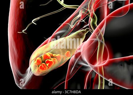 Illustration d'une vésicule biliaire avec des calculs, montrant la lithiase biliaire. Les calculs biliaires peuvent bloquer le flux biliaire et causer de la douleur, de l’inflammation ou une infection nécessitant un traitement médical ou chirurgical. Banque D'Images