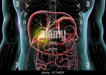 Illustration d'une vésicule biliaire avec des calculs, montrant la lithiase biliaire. Les calculs biliaires peuvent bloquer le flux biliaire et causer de la douleur, de l’inflammation ou une infection nécessitant un traitement médical ou chirurgical. Banque D'Images