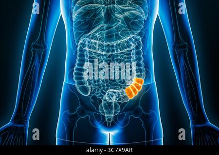 Vue radiographique antérieure de la jonction sigmoïde descendante ou flexion sigmoïde du côlon en 3D avec contours corporels. Anatomie, organe de DIG Banque D'Images