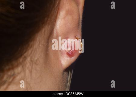 Abcès rouge et gonflé au site de perçage des oreilles, indiquant une infection probable due à une mauvaise hygiène ou à une irritation. Banque D'Images