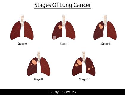 Étapes de l'illustration vectorielle du cancer du poumon Illustration de Vecteur