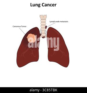 Illustration vectorielle du cancer du poumon Illustration de Vecteur