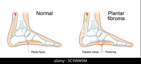 Fibromatose fasciale plantaire. Fibrome plantaire. Maladie de Ledderhose. Morbus Ledderhose. Squelette du pied. Aspect médial des os et fascia plantaire wi Illustration de Vecteur