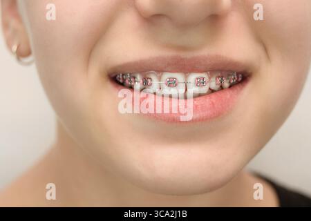Gros plan du sourire avec des accolades et des bandes roses mettant en évidence les soins dentaires santé dentaire et les bonnes pratiques d'hygiène bucco-dentaire pour obtenir une belle et alig Banque D'Images