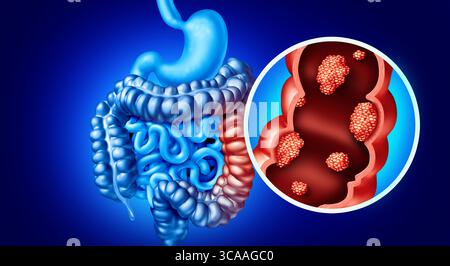 Concept de cancer colorectal comme une maladie du côlon illustration médicale d'un gros intestin avec une maladie de croissance tumorale maligne du système digestif. Banque D'Images