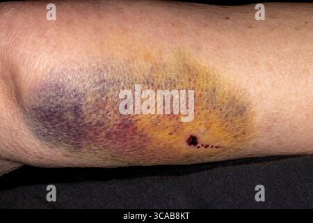 Vadnais Heights, Minnesota. Ecchymose sur le bras d'une femme âgée de tomber. Banque D'Images