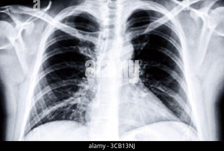 Détail d'une radiographie des poumons masculins. Noir et blanc. Banque D'Images