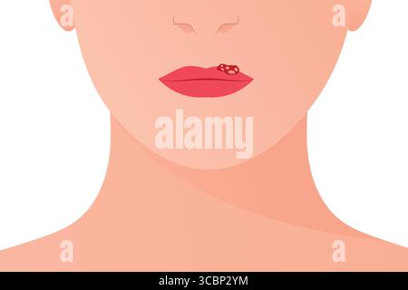 virus de l'herpès simplex sur les lèvres ; symptômes contagieux de mal de froid, cloques de lèvre, et infection virale de la peau idéal pour l'éducation, les soins de santé, et préveni Illustration de Vecteur