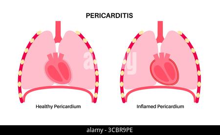 Illustration d'une péricardite cardiaque. Il s'agit d'une affection cardiaque caractérisée par une inflammation du péricarde, la structure semblable à un sac entourant le cœur. Une douleur thoracique aiguë est un symptôme courant, qui s’aggrave souvent avec des respirations profondes, couché ou toux. Elle peut être déclenchée par des infections virales ou bactériennes, des maladies auto-immunes ou des crises cardiaques. Banque D'Images