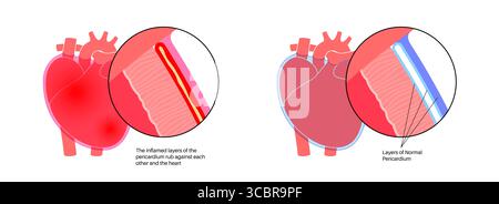 Illustration d'une péricardite cardiaque. Il s'agit d'une affection cardiaque caractérisée par une inflammation du péricarde, la structure semblable à un sac entourant le cœur. Une douleur thoracique aiguë est un symptôme courant, qui s’aggrave souvent avec des respirations profondes, couché ou toux. Elle peut être déclenchée par des infections virales ou bactériennes, des maladies auto-immunes ou des crises cardiaques. Banque D'Images