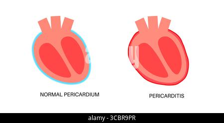 Illustration d'une péricardite cardiaque. Il s'agit d'une affection cardiaque caractérisée par une inflammation du péricarde, la structure semblable à un sac entourant le cœur. Une douleur thoracique aiguë est un symptôme courant, qui s’aggrave souvent avec des respirations profondes, couché ou toux. Elle peut être déclenchée par des infections virales ou bactériennes, des maladies auto-immunes ou des crises cardiaques. Banque D'Images