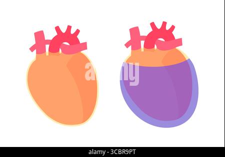 Illustration d'épanchement péricardique du coeur. Il s'agit de l'accumulation d'excès de liquide dans l'espace péricardique, le sac entourant le cœur. Cette accumulation de liquide peut exercer une pression sur le cœur, ce qui peut nuire à sa capacité à pomper efficacement le sang. Banque D'Images