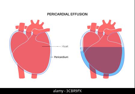 Illustration d'épanchement péricardique du coeur. Il s'agit de l'accumulation d'excès de liquide dans l'espace péricardique, le sac entourant le cœur. Cette accumulation de liquide peut exercer une pression sur le cœur, ce qui peut nuire à sa capacité à pomper efficacement le sang. Banque D'Images