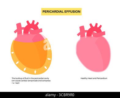 Illustration d'épanchement péricardique du coeur. Il s'agit de l'accumulation d'excès de liquide dans l'espace péricardique, le sac entourant le cœur. Cette accumulation de liquide peut exercer une pression sur le cœur, ce qui peut nuire à sa capacité à pomper efficacement le sang. Banque D'Images