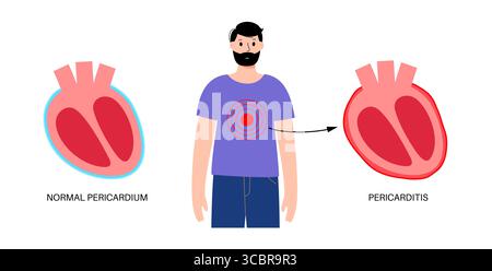 Illustration d'une péricardite cardiaque. Il s'agit d'une affection cardiaque caractérisée par une inflammation du péricarde, la structure semblable à un sac entourant le cœur. Une douleur thoracique aiguë est un symptôme courant, qui s’aggrave souvent avec des respirations profondes, couché ou toux. Elle peut être déclenchée par des infections virales ou bactériennes, des maladies auto-immunes ou des crises cardiaques. Banque D'Images