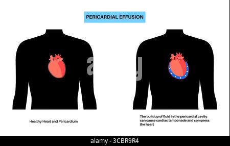 Illustration d'épanchement péricardique du coeur. Il s'agit de l'accumulation d'excès de liquide dans l'espace péricardique, le sac entourant le cœur. Cette accumulation de liquide peut exercer une pression sur le cœur, ce qui peut nuire à sa capacité à pomper efficacement le sang. Banque D'Images