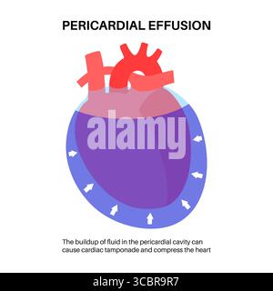 Illustration d'épanchement péricardique du coeur. Il s'agit de l'accumulation d'excès de liquide dans l'espace péricardique, le sac entourant le cœur. Cette accumulation de liquide peut exercer une pression sur le cœur, ce qui peut nuire à sa capacité à pomper efficacement le sang. Banque D'Images