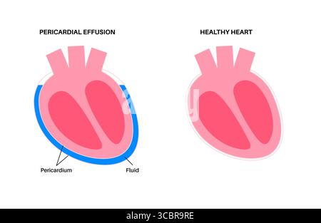 Illustration d'épanchement péricardique du coeur. Il s'agit de l'accumulation d'excès de liquide dans l'espace péricardique, le sac entourant le cœur. Cette accumulation de liquide peut exercer une pression sur le cœur, ce qui peut nuire à sa capacité à pomper efficacement le sang. Banque D'Images