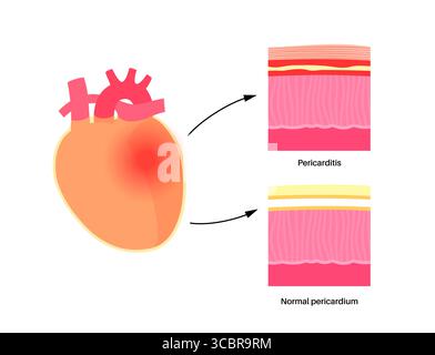 Illustration d'une péricardite cardiaque. Il s'agit d'une affection cardiaque caractérisée par une inflammation du péricarde, la structure semblable à un sac entourant le cœur. Une douleur thoracique aiguë est un symptôme courant, qui s’aggrave souvent avec des respirations profondes, couché ou toux. Elle peut être déclenchée par des infections virales ou bactériennes, des maladies auto-immunes ou des crises cardiaques. Banque D'Images
