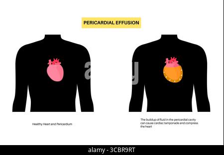 Illustration d'épanchement péricardique du coeur. Il s'agit de l'accumulation d'excès de liquide dans l'espace péricardique, le sac entourant le cœur. Cette accumulation de liquide peut exercer une pression sur le cœur, ce qui peut nuire à sa capacité à pomper efficacement le sang. Banque D'Images