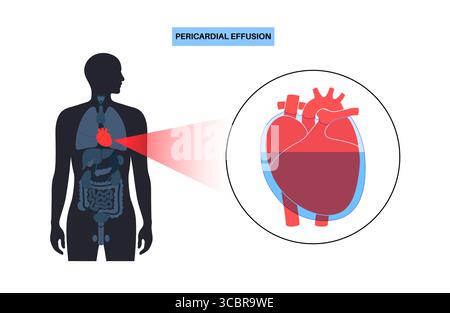 Illustration d'épanchement péricardique du coeur. Il s'agit de l'accumulation d'excès de liquide dans l'espace péricardique, le sac entourant le cœur. Cette accumulation de liquide peut exercer une pression sur le cœur, ce qui peut nuire à sa capacité à pomper efficacement le sang. Banque D'Images