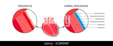 Illustration d'une péricardite cardiaque. Il s'agit d'une affection cardiaque caractérisée par une inflammation du péricarde, la structure semblable à un sac entourant le cœur. Une douleur thoracique aiguë est un symptôme courant, qui s’aggrave souvent avec des respirations profondes, couché ou toux. Elle peut être déclenchée par des infections virales ou bactériennes, des maladies auto-immunes ou des crises cardiaques. Banque D'Images