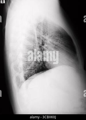 Détail d'une radiographie des poumons et du thorax masculins. Noir et blanc. Vue latérale. Banque D'Images