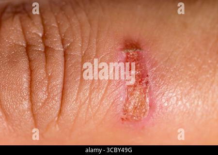 Gros plan image de brûlure grave sur un doigt de femme de la cuisson Banque D'Images