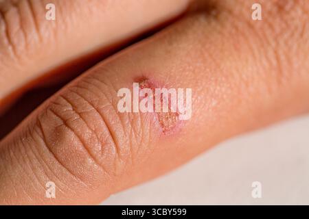 Gros plan image de brûlure grave sur un doigt de femme de la cuisson Banque D'Images