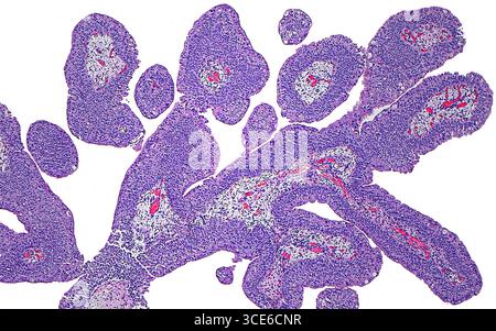 Papillome urothélial par micrographie à la lumière. Un papillome urothélial est une croissance bénigne qui se produit dans les voies urinaires. Le papillome est composé de fines papilles ou de structures en forme de doigts, avec des noyaux fibrovasculaires (blancs avec des stries rouges vives) et bordés de cellules urothéliales bénignes (violettes). Coupe de tissu colorée à l'hématoxyline et à l'éosine. Grossissement : 40x lorsqu'il est imprimé à 10cm. Banque D'Images